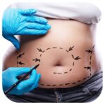 Staged Liposuction in London: When Multiple Sessions Improve Safety and Contour for Large-Volume Fat Removal