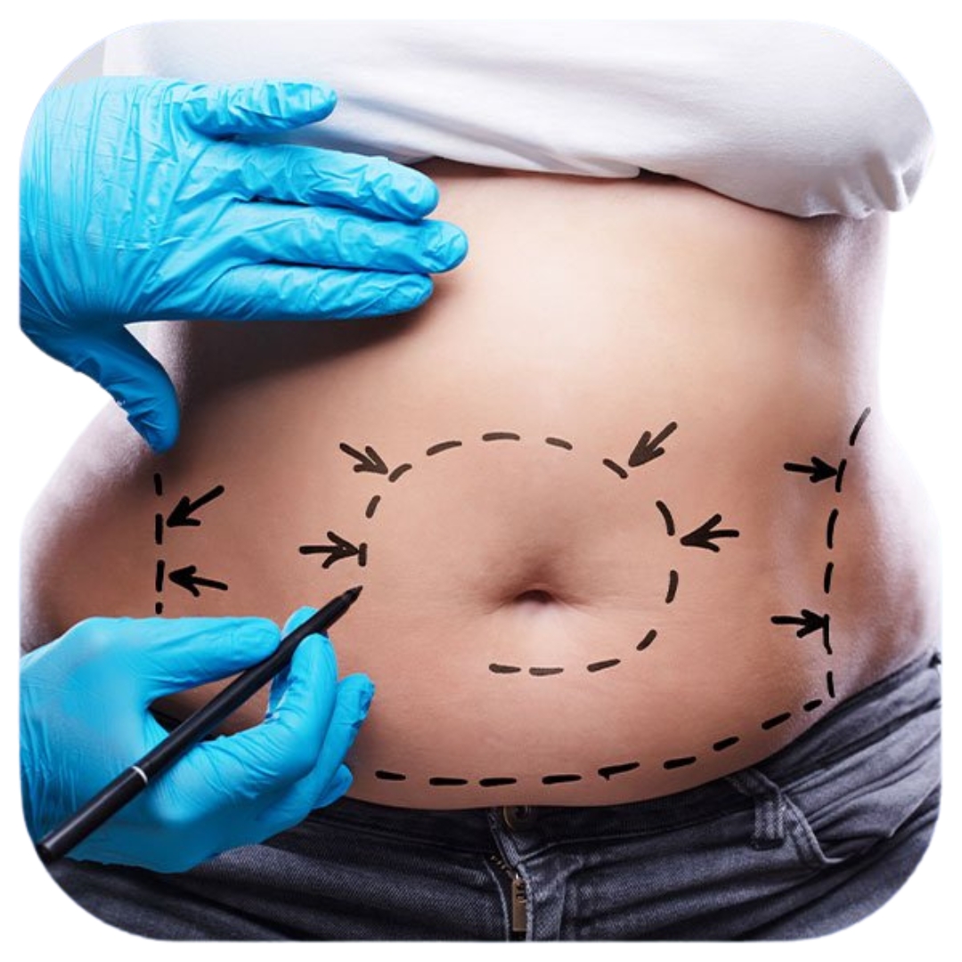 Staged Liposuction in London: When Multiple Sessions Improve Safety and Contour for Large-Volume Fat Removal