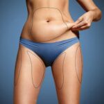 When to Combine a Tummy Tuck (Abdominoplasty) with Hernia Repair: Guidance for London Patients