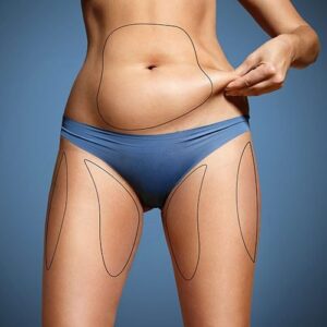 Tummy Tuck in London