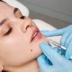 Why Opt for Bullhorn Lip Lift Over Traditional Methods for Upper Lip Enhancement