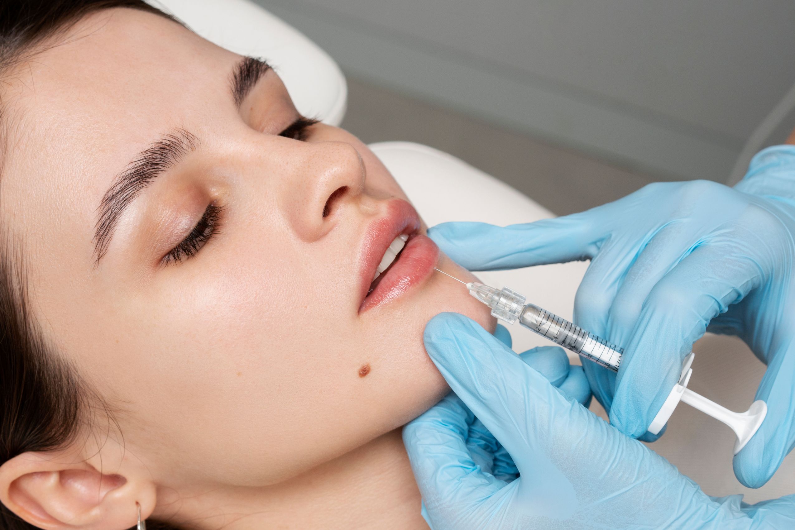 Why Opt for Bullhorn Lip Lift Over Traditional Methods for Upper Lip Enhancement