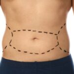 Mini Tummy Tuck Vs Full Tummy Tuck: Which Addresses Lower Abdominal Laxity Best