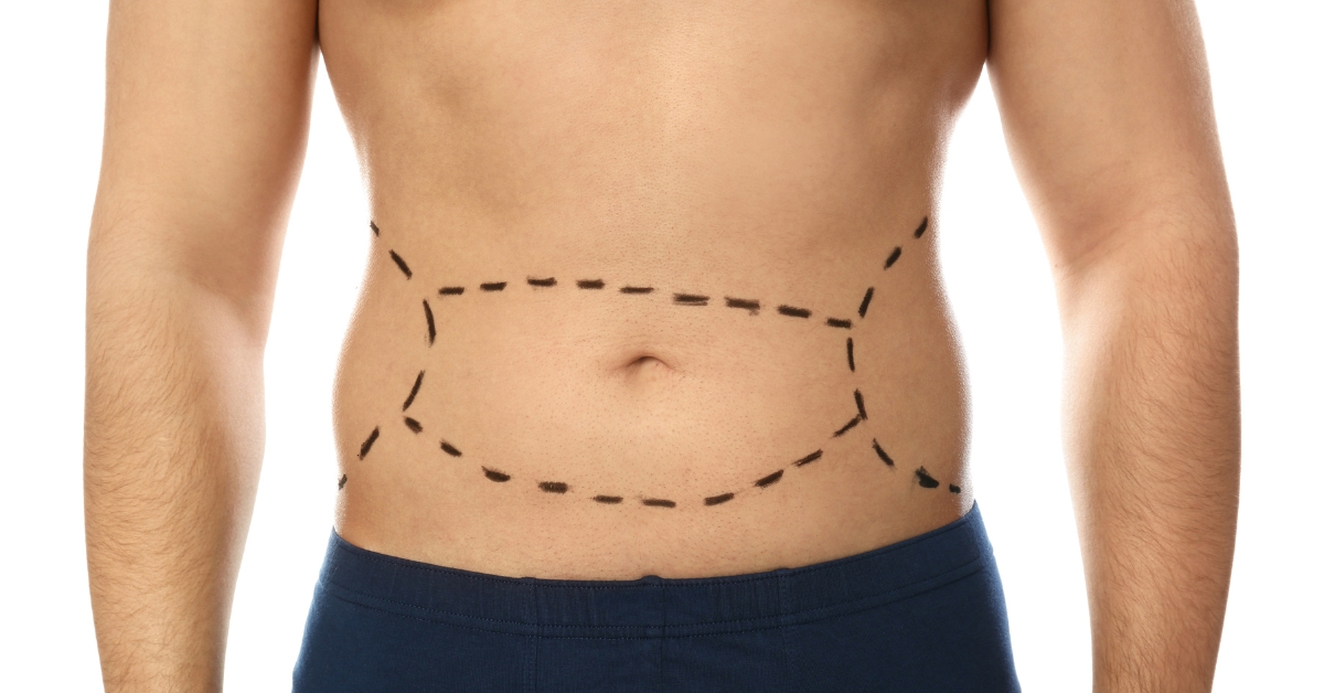 Mini Tummy Tuck Vs Full Tummy Tuck: Which Addresses Lower Abdominal Laxity Best