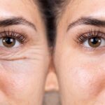 Transconjunctival vs Transcutaneous Lower Eyelid Surgery in London: Choosing the Right Approach for Eye Bags and Hollows