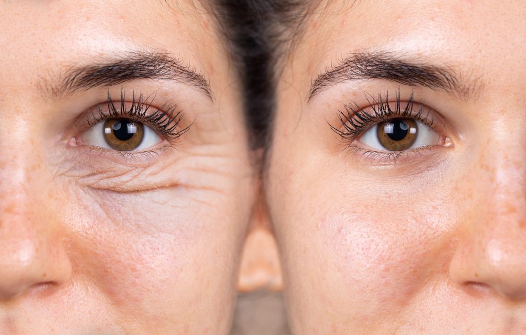 Transconjunctival vs Transcutaneous Lower Eyelid Surgery in London: Choosing the Right Approach for Eye Bags and Hollows