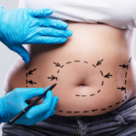 When Surgeons Recommend Lipoabdominoplasty over a Standard Tummy Tuck in London
