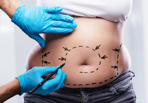 When Surgeons Recommend Lipoabdominoplasty over a Standard Tummy Tuck in London